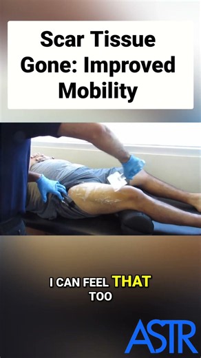 Knee Pain Disappears with ASTR Treatment #shorts