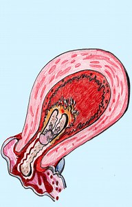 TRATAMIENTO DEL ABORTO - Aula Ginecología