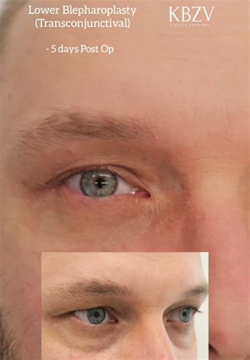 Blepharoplasty Recovery: 5 Days Post-Op Insights