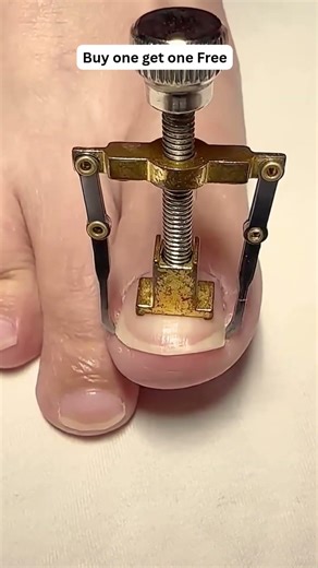 🔥Ingrown Toenail Fix at Home | Best Ingrown Toenail Corrector #3625 ‪@sovorsgadget‬