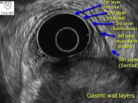EUS gastric wall layers