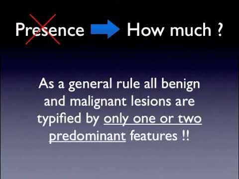 Melanoma criteria 1/3 by Dr. Giuseppe Argenziano