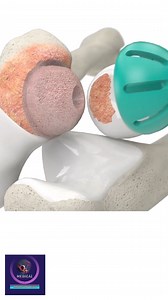 6.3K views · 65 reactions | Elbow Fracture and Fixation (Resurfacing) #reels #elbow | Medical Animation Media | Facebook