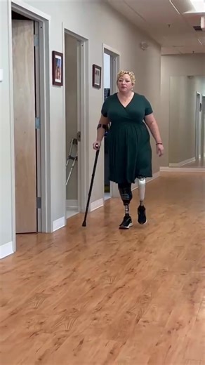 This week Laura had the opportunity to trial several different microprocessors knees. Laura wears bilateral prostheses. A right below the knee vacuum socket technology prosthesis and a left above the knee prosthesis with #osseointergration. Laura was seen in our new office on Long Island. Melville NY! @sunwisecounseling #prostheticsinmotion #amputeestrong #amputeetiktok #bilateralamputee