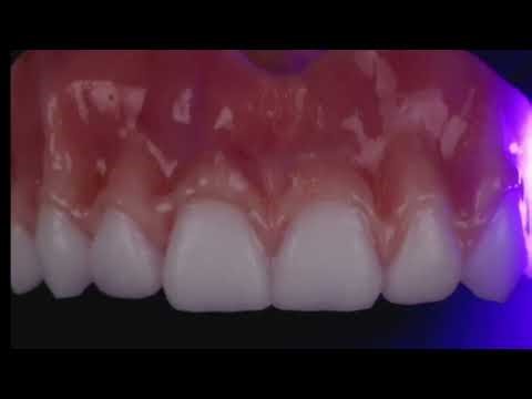 TOP TIP: Join me as I explain how I characterize my 3D printed dentures.