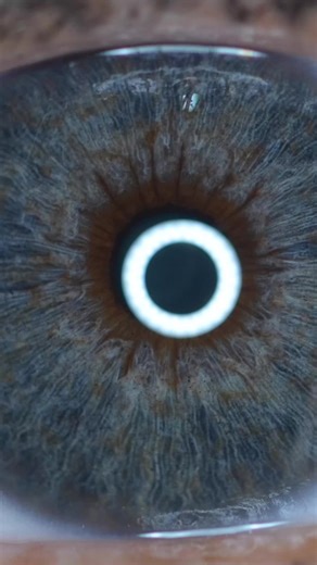 Dany's Eye Color Transformation Experience at Iris Color Laser