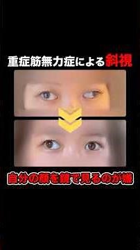 【重症筋無力症による斜視】神経整体で喜びの声！！ #神経整体 #神経整体技術塾