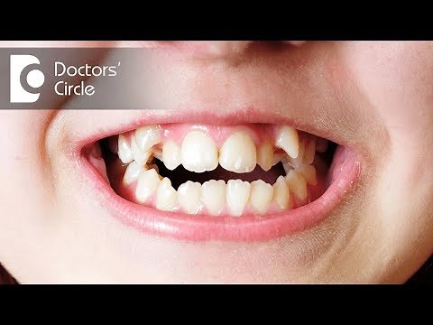 Types of Malocclusion - Dr. Manissha Agarwal