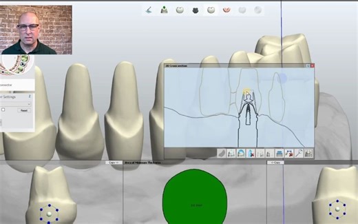 3Shape 马龙桥设计