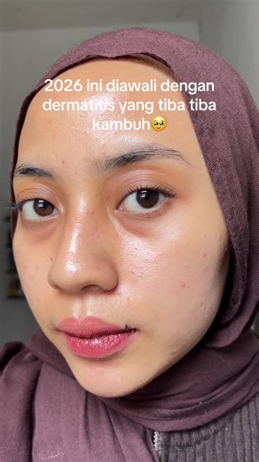 penanganannya👇🏻 - Pakai facewash gentle yg gak bikin keset after dibilas (hadalabo, facerinna, cethapil, glowbee) - Pakai moisturizer yg gandungannya bisa ngecalming (labore topicalm, labore barrier revive, skintific biru, dewmee, lrp) - Pakai sunscreen jika keluar rumah saja - Hindari makeup terlebih dahulu - Hindari double cleansing dg kapas - Hindari seafood - Jika tidak kunjung reda bawa ke SPKK yaa🤍🤍 Happy New year 2026✨