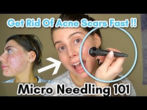How to Microneedle Easy and Safe For Acne Scars!! || Heal Skin, Produce Collagen, Glow.