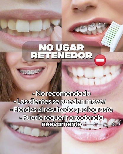 Types of retainers I recommend 👀 #retainers #braces #aligners #braces #orthodontics