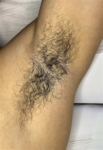 Depilação e Clareamento de Axilas na Gravidez
