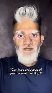 When I was a kid, a lot of people thought my face was burned. I’d tell them no, it’s vitiligo, but they’d act like they’d never even heard of it before. I don’t blame them though they were young, and kids don’t really understand things like that. Fast forward to now, and it still happens. People come up to me feeling sorry for me, and I politely tell them there’s nothing to be sorry about. It’s vitiligo, and I was born with it. They usually look confused, but I don’t expect everyone to know what