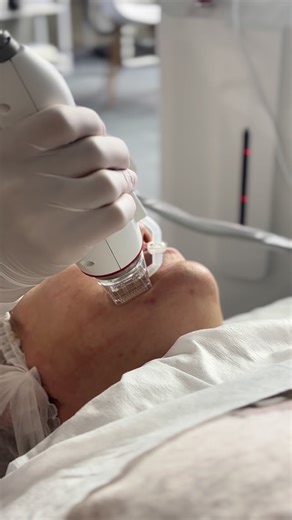 Nan Wang on Instagram: "Do you know how RF microneedling works? The complete process of RF microneedling (three steps): 1: Insertion Phase (Needle Insertion): 2: Action Phase (Dwelling and Emission): 3: Withdrawal Phase (Needle Removal): The significant advantages of this design: 1: Epidermal Protection: Avoids heat generation when the needle penetrates the epidermis, minimizing excessive burns and reducing the risk of pigmentation and crusting. 2: Precise Treatment: Energy can be 100% applied t