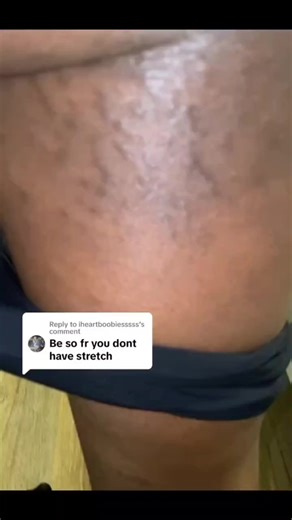 stretch marks remove before and after