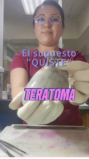 Teratoma en ovarios: un vistazo a los quistes