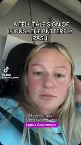 A malar rash, AKA butterfly rash, is a red, itchy, or painful rash that appears on the cheeks & bridge of the nose in people with lupus. The rash is shaped like a butterfly & can last days, weeks or more. It can appear spontaneously or after sun exposure and indicates that there is increased inflammation in your body. It often appears before or at the start of a flare. 🦋💜 #lupus #lupusawareness #sle #lupuswarrior #lupussurvivor #lupusfighter #lupuslife #lupusreality #lupusresearch #lupusflare 