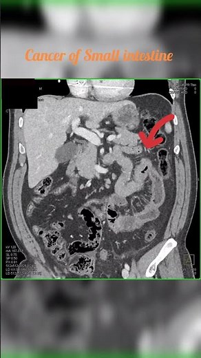 Small intestine cancer #shorts #healthmedia #7428617074