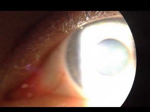 Bilateral tonic pupils vermiform pupil movement