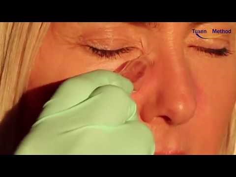 How to treat blocked tear ducts with cupping / vacuum pressure