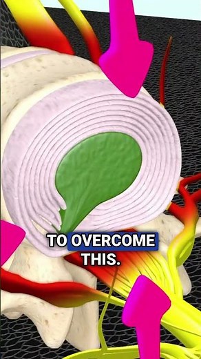 How Spinal Decompression Helped End Back & Leg Pain—Start Your Healing Journey #BackPainRelief