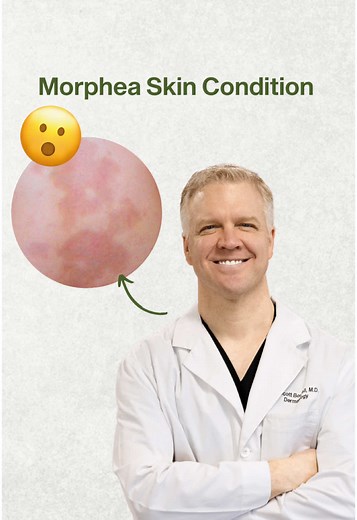 Understanding Morphea: Symptoms and Management