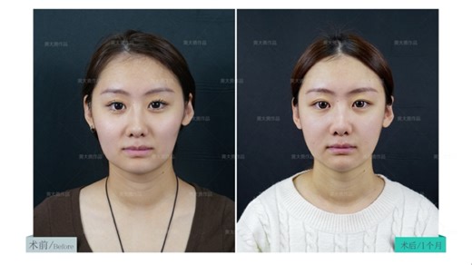 改脸型1个月复查！颧骨内推 BodyTite双buff，轮廓流畅直接上镜自由～