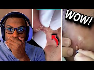 Can You Handle These Giant CYST Pops?