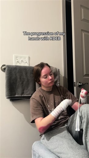 Understanding RDEB: My Journey and Hope