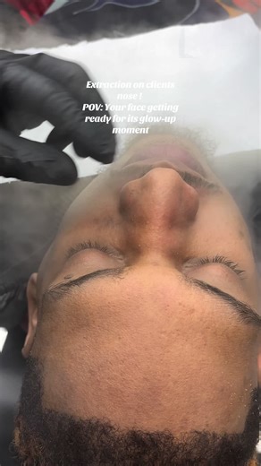 Essential Guide to Facial Extractions for Glowing Skin