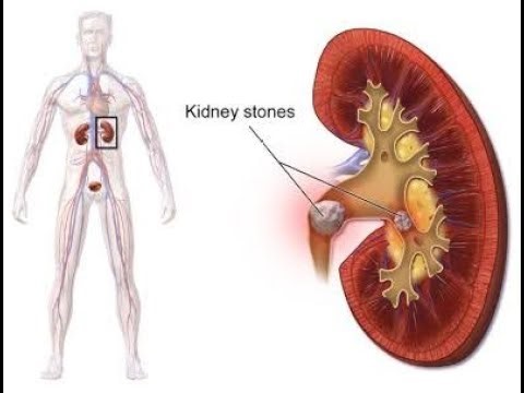 Test Procedure And Observation of Renal stone analysis - Kidney Stones