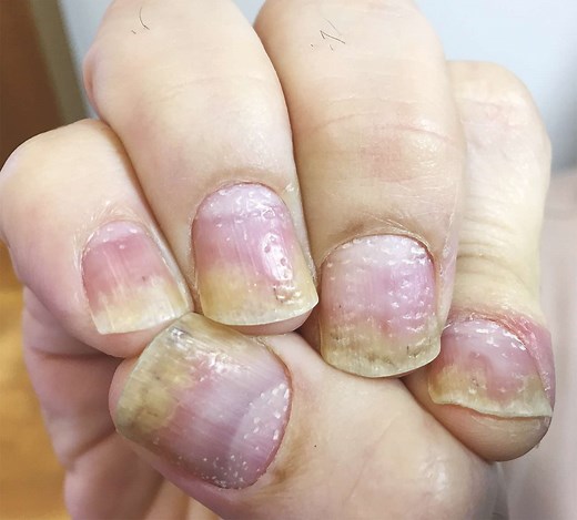 Why you should take pits in your fingernails seriously
