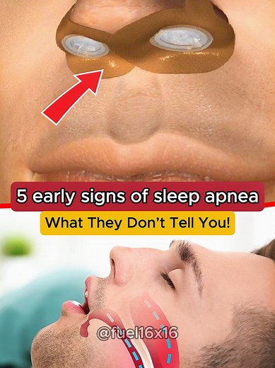 Understanding Sleep Apnea: Signs and Treatments