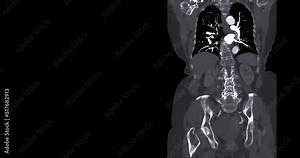 CTA whole aorta for diagnonsis aortic aneurysm.