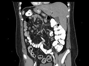 ADENITIS MESENTERICA - INFLAMACIÓN GANGLIONAR LINFÁTICA MESNETERICA ABDOMINAL