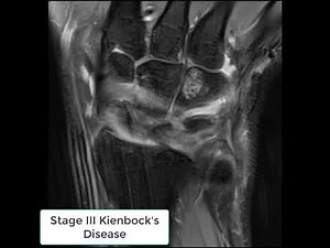 Stage III Kienbock's Disease