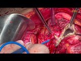 Ovarian Cancer Cytoreductive Surgery. Unedited version. Part III Pelvis. • Video • MEDtube.net