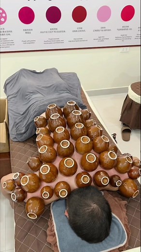 Improving Health Through Cupping Therapy