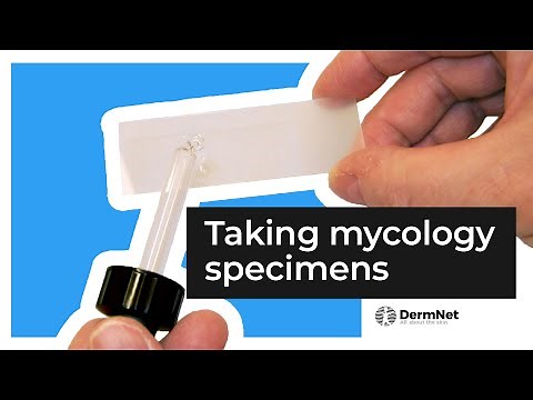 Fungal infections: taking a mycology sample