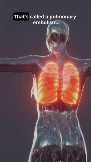The Leg Pain That Can Reach Your Lungs