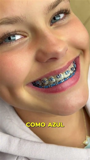 Pare De Escolher Essas Cores De Aparelho Ortodôntico 😬