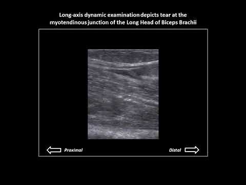 Complete tear of the long head of biceps brachii tendon on ultrasound
