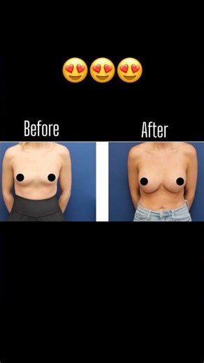 Breast Augmentation Before & After | Patient Transformation