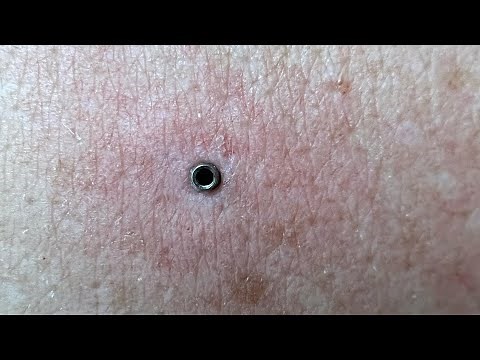 HOW TO REMOVE A MICRODERMAL IN 3 SECONDS WITHOUT DOING ANY DAMAGE! 💉🪡💪😷