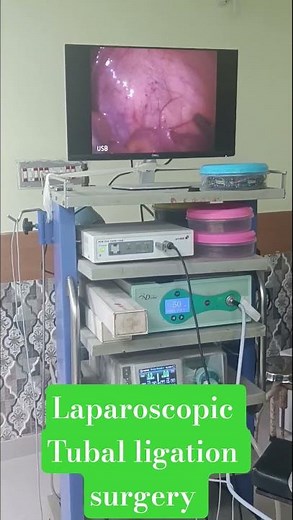 Laparoscopic Tubal ligation Surgery #hospital #doctor #shortvideo #hospitalstaff #youtubeshorts