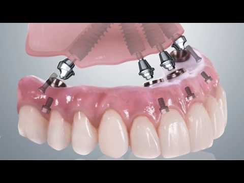 Prótesis híbrida sobre Implantes - Madrid