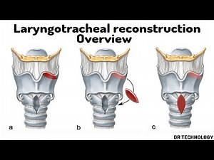 Laryngotracheal reconstruction Overview | Get overview of the laryngotracheal reconstruction surgery