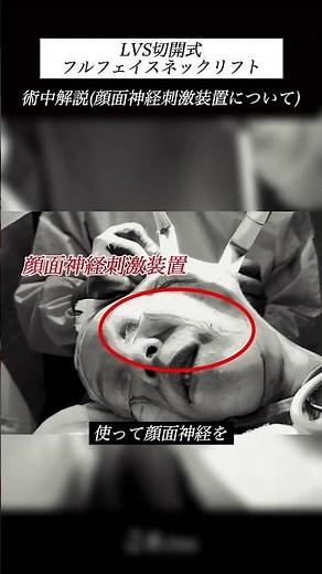 [What is a facial nerve stimulator? | *Intraoperative explanation*]