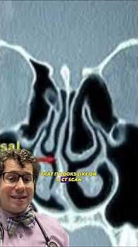 How to tell if you have a deviated nasal septum